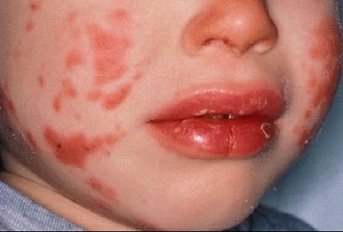 Pediatric Dermatology